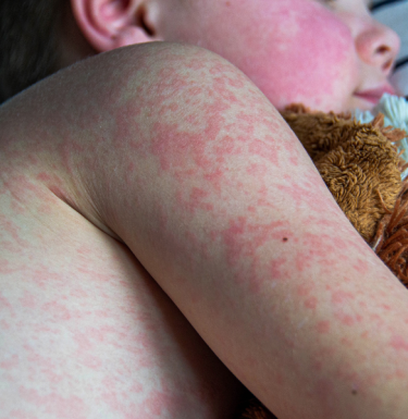 baby with measles laying down with stuffie