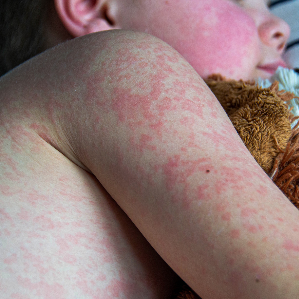 baby with measles laying down with stuffie